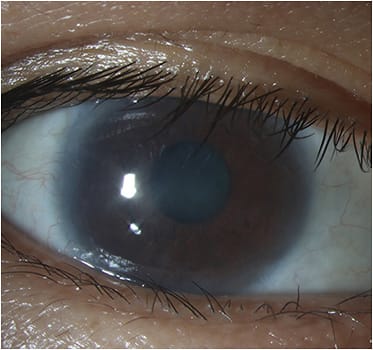 FIGURE 3: Eighteen months after SLET. Cornea looks clear without epithelial defects and VA was 20/70. IMAGE COURTESY GUILLERMO AMESCUA, MD