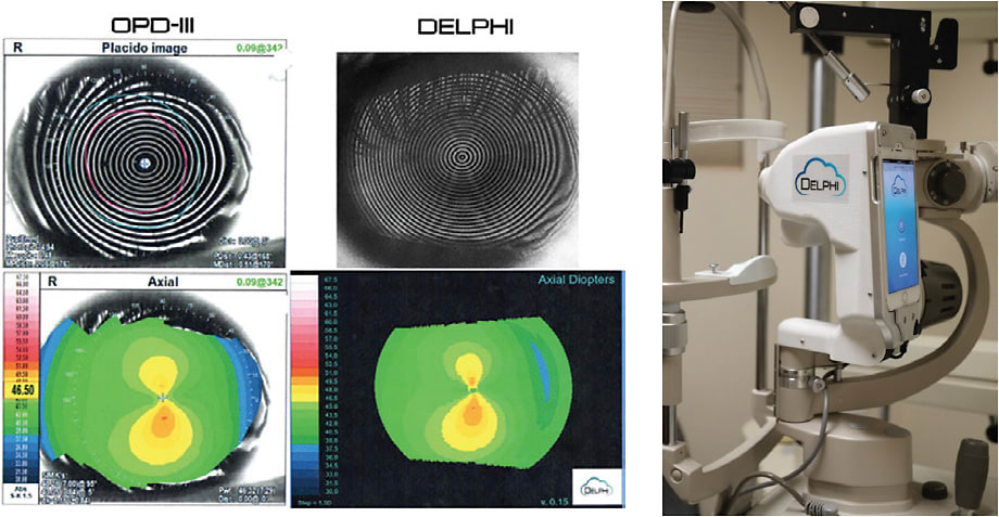 (Left to right) Nidek OPD-Scan III and Delphi maps and Delphi device.