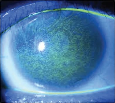 Staining reveals dry eye disease, which can be managed in-office. IMAGE COURTESY JENNIFER LOH, MD