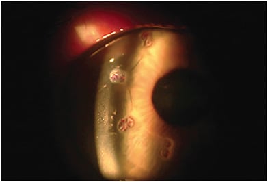 FIGURE 1: CK’s principal of correcting presbyopia and low hyperopia by flattening the peripheral cornea to steepen the central cornea can be applied to a cornea that has a decentralized cone when combined with CXL.IMAGE COURTESY DANIEL DURRIE, M.D.