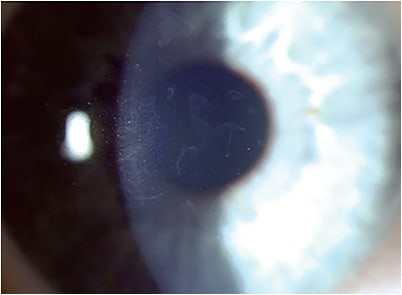 Patients who have EBMD present with sharply demarcated, faint grey-white opacities, as well as grey microcysts and fingerprint lines within the corneal epithelium. Grey-white opacities can induce irregular astigmatism. IMAGE COURTESY CLARA C. CHAN, MD Patients who have EBMD present with sharply demarcated, faint grey-white opacities, as well as grey microcysts and fingerprint lines within the corneal epithelium. Grey-white opacities can induce irregular astigmatism. IMAGE COURTESY CLARA C. CHAN, MD