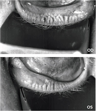 Meibography showing meibomian gland drop out with structural gland changes.