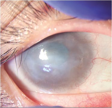 FIGURE 1: Total, unilateral limbal stem cell deficiency with 360-degree neovascularization in the right eye of a 38-year-old female patient who had a history of recurrent keratitis, presumed to be herpetic in origin. Visual acuity was 20/800. IMAGE COURTESY GUILLERMO AMESCUA, MD