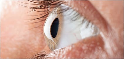 Certain socioeconomic risk factors may indicate a tougher battle against the ocular bulge. IMAGE COURTESY STOCK.ADOBE.COM