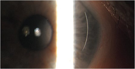 FIGURE 5: Slit lamp image of femto second arcuate incision. IMAGE COURTESY DEE STEPHENSON