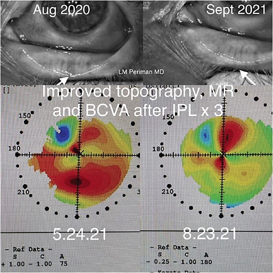 FIGURE 3: Pre-cataract surgery patient with improved best-corrected visual acuity and topography after 3 IPL sessions. IMAGE COURTESY LAURA M. PERIMAN, MD