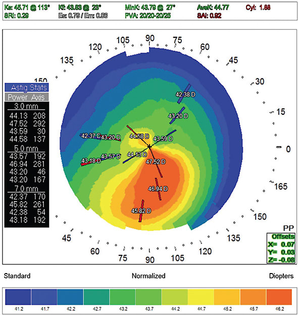 FIGURE 1. Detecting surface irregularities aids in premium IOL patient selection.