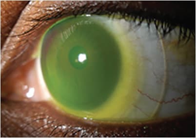 Diffuse illumination showing a well-fit scleral lens filled with saline and sodium fluorescein on an eye that has KCN. IMAGE COURTESY ELISE KRAMER, OD, FAAO, FSLS