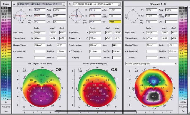 This image underlines the remarkable normalization from the preoperative eye on the left to the postoperative eye in the middle, and the difference in cornea curvature depicted in the right image. When we focus on the flattened core area, we see it has flattened by 8.3 dpt, but also the flat superior area above the cone has grown steeper by 6.1 dpt! IMAGES COURTESY A. JOHN KANELLOPOULOS, MD