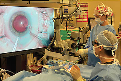 FIGURE 3: When a post-CXL patient develops presbyopia or cataract, an option is to replace the crystalline lens with a pseudophakic IOL. IMAGE COURTESY JOSEPH LING MD, &amp; WILLIAM F. WILEY, MD