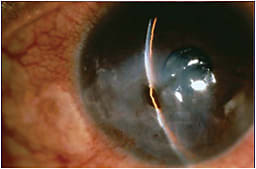 Progression to corneal perforation.