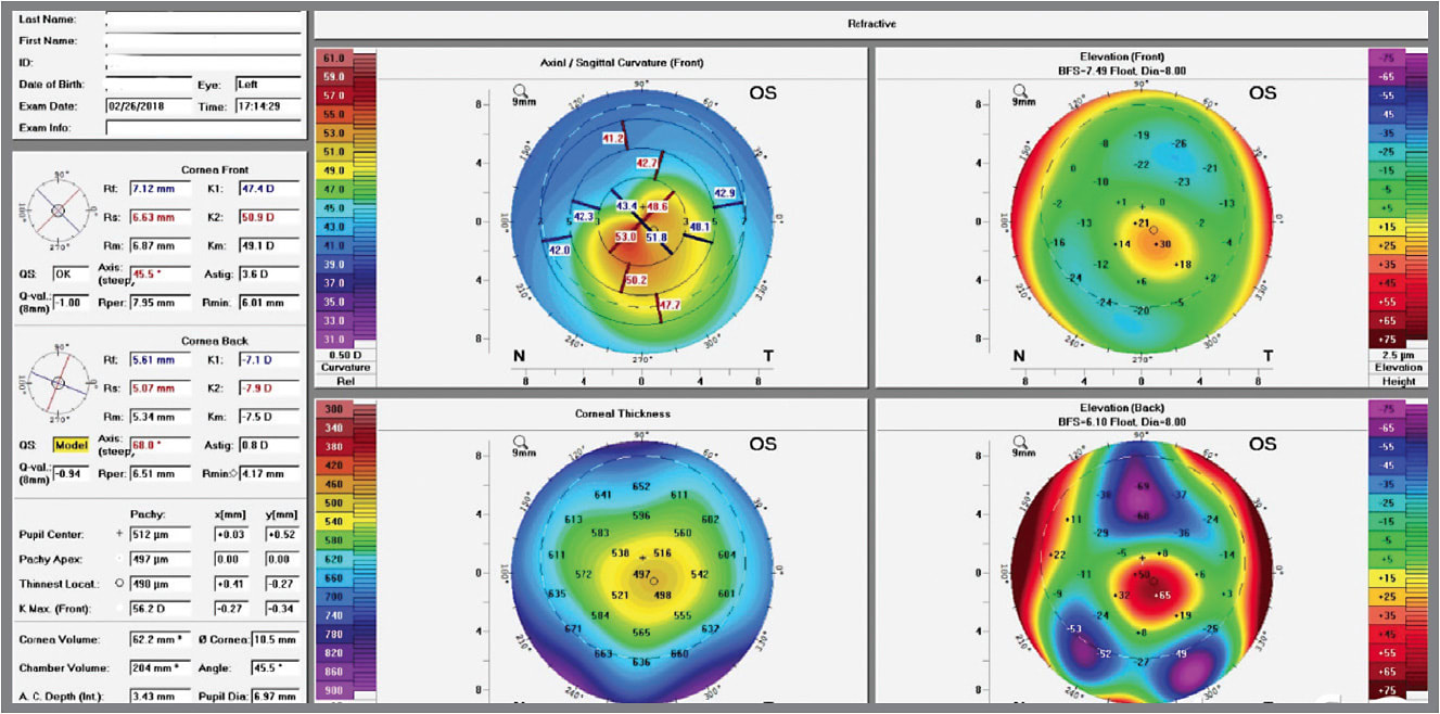 FIGURE 2. Scheimpflug-based corneal tomography reveals abnormnal posterior elevation in keratoconus.