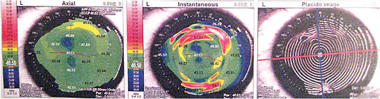 FIGURE 2: Topography mires in Salzmann’s nodules appear distorted.