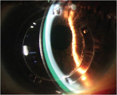 Optic section showing the cornea, scleral lens tear film reservoir, and scleral lens on an eye that has KCN and intracorneal ring segments. IMAGE COURTESY ELISE KRAMER, OD, FAAO, FSLS