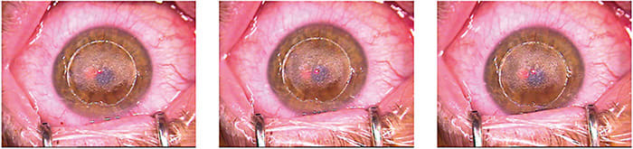 Figure 7: Note the intraoperative photos during flap amputation and excimer bed ablation. IMAGE COURTESY HANS W. ANDREWS, MD