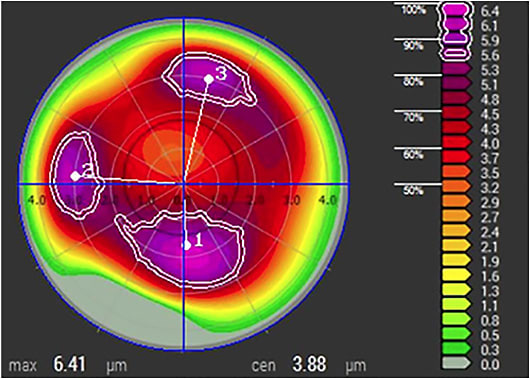 Talus astigmatism after zeroing out sphere and cylinder.