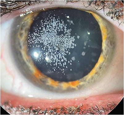 Figure 4: Note the granular corneal deposits OS. IMAGE COURTESY HANS W. ANDREWS, MD