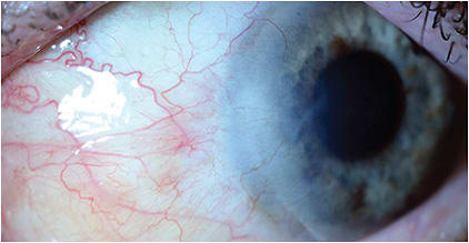 FIGURE 3: After 5 cycles of topical chemotherapy, the patient had no clinical signs of OSSN on slit lamp examination of the cornea and conjunctiva. IMAGE COURTESY BEERAN MEGHPARA, MD