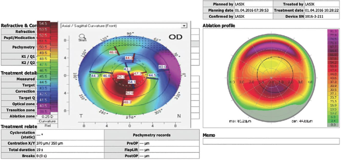 FIGURE 1: Keratoconus topography with a corresponding topographic ablation pattern showing an inferior myopic and superior hyperopic treatment.