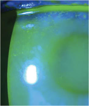 Severe punctate corneal staining in a patient using a topical prostaglandin analogue.