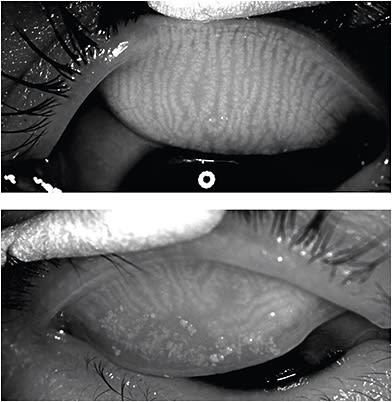 Above: Note the healthy meibomian glands. Below: Note the shortened atrophic glands. Patients who have MGD have many in-office treatment options. IMAGE COURTESY JENNIFER LOH, MD