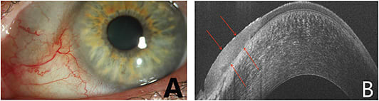 FIGURE 3. A and B: AS-OCT provides an optical biopsy of the ocular surface.