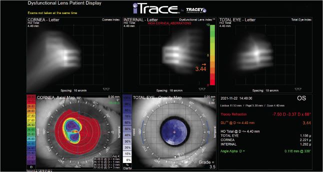 FIGURE 1: Note KB’s corneal flattening. IMAGE COURTESY MITCHELL C. SHULTZ, MD, FAAO