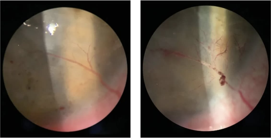 Left: CNV prior to laser thermal cauterization with an argon laser. Right: CNV after laser thermal cauterization with an argon laser. Laser thermal cauterization is often combined with anti-VEGF agents due to the upregulation of VEGF from the inflammatory response of heat-induced coagulation and vessel occlusion. IMAGES COURTESY ALBERT Y. CHEUNG, MD