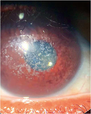 Figure 1: Note the preoperative granular deposits in the anterior and mid stroma OD. IMAGE COURTESY HANS W. ANDREWS, MD