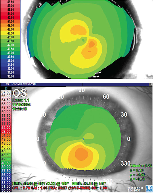 FIGURE 6A-6B: Top: Pellucid marginal degeneration topographic suspect with skewing of the radial axes. One presentation form of keratoconus. Bottom: Note the inferior early keratoconus. Typically, such eyes should not be considered candidates for PRK, LASIK, LASEK, or SMILE. IMAGE COURTESY STEVEN E. WILSON, MD
