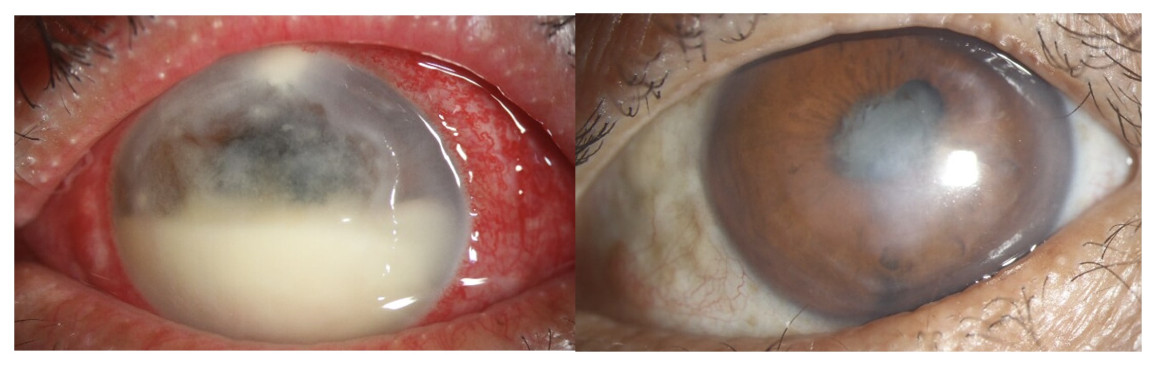Slit-lamp photograph of a patient with Pseudomonas aeruginosa keratitis (left), who was successfully treated with medical therapy and RB-PDAT. (Right)
