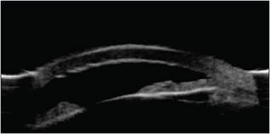 Figure 2. Ultrasound biomicroscopy image of an eye with plateau iris configuration. Note flat ciliary processes and no ciliary sulcus.