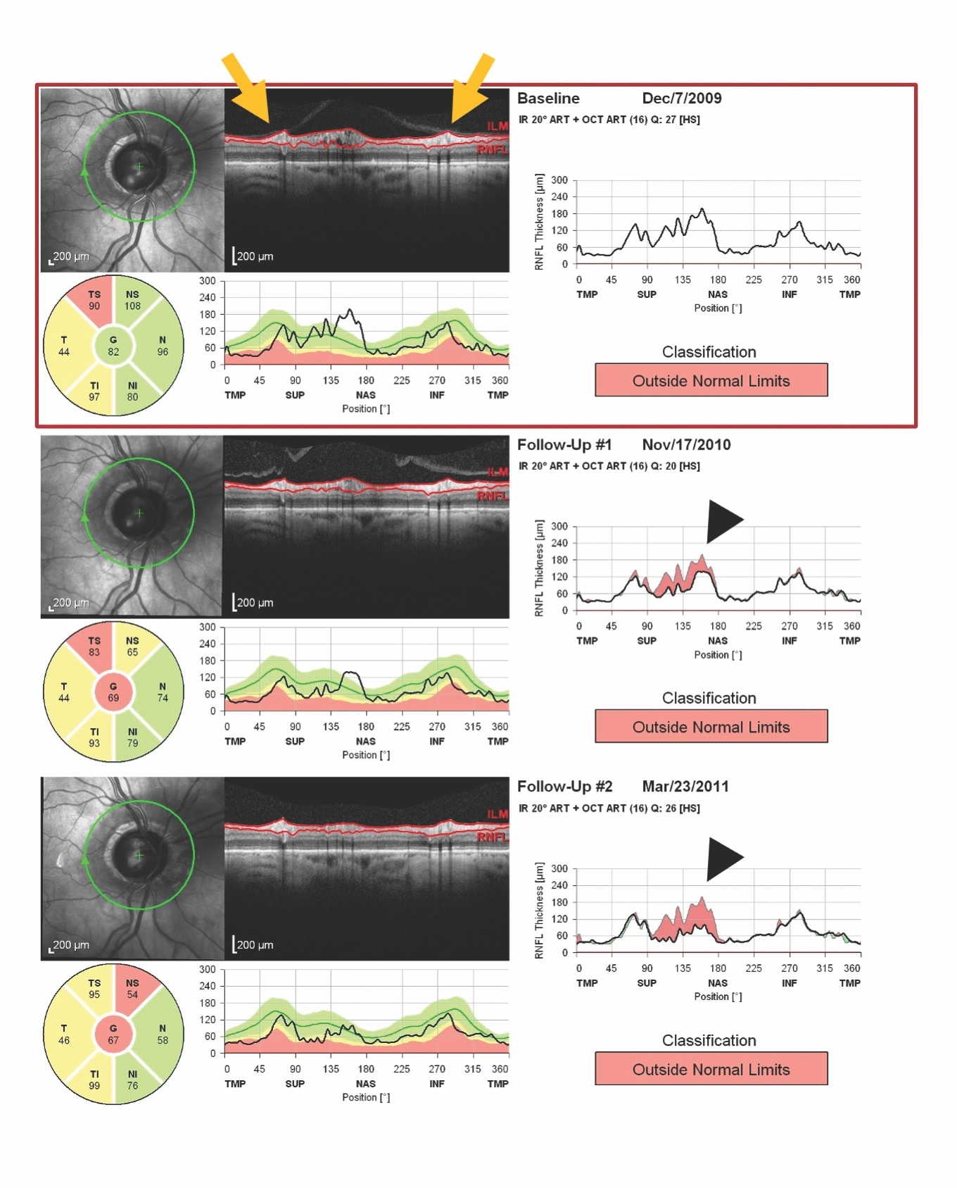 Figure 3Figure 3. Optical coherence tomography RNFL scan demonstrating vitreous traction on the peripapillary RNFL (arrows) with subsequent release and artifactual thinning of RNFL (arrowheads).