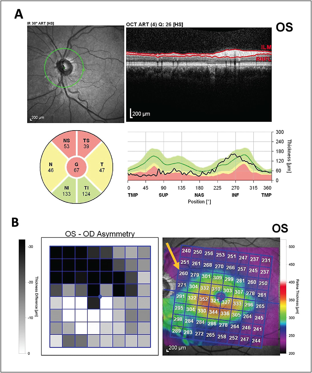 Figure 2. Optical coherence tomography following nonarteritic ischemic optic neuropathy with (A) peripapillary RNFL demonstrating abrupt complete loss of the superior RNFL and (B) macular thickness scan highlighting concurrent severe superior hemispheric tissue loss that is especially prominent nasally (arrow).