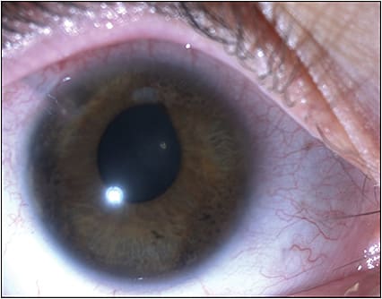 Figure 2. Slit-lamp photo showing previous superotemporal tube shunt and mild corectopia in patient after micropulse transcleral diode laser cyclophotocoagulation with Iridex Cyclo G6 laser. PHOTOGRAPHER: D. HARRIS, MD