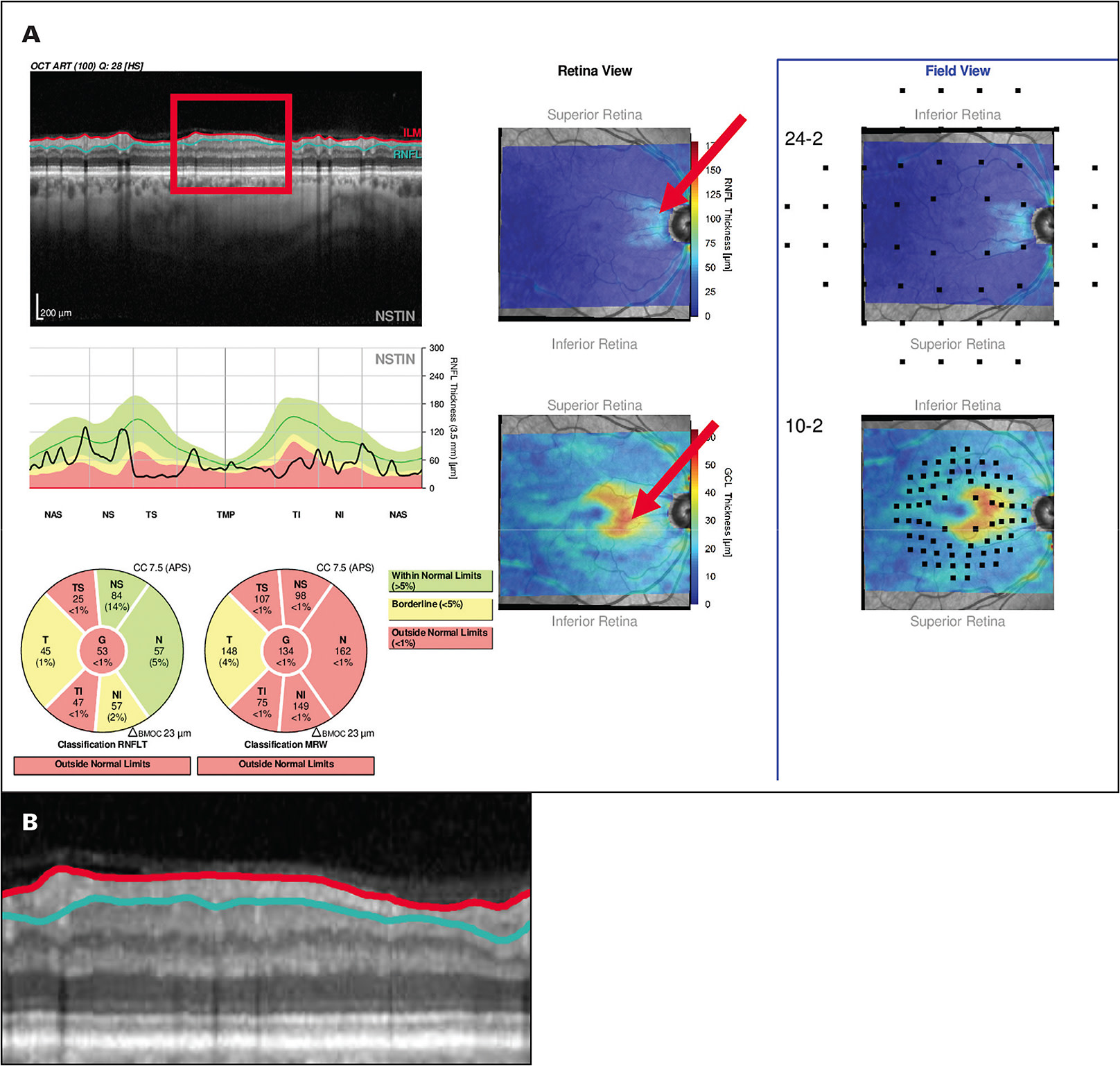 Figure 2. The Hood Report of an eye with advance glaucoma (A). The red rectangle is the portion of the B-scan associated with about ±8° from fixation. This region is shown enlarged in panel B. Note that the global circumpapillary retinal nerve fiber layer thickness (RFNL) is only 52 µm, a value commonly thought to be too small to be of use. However, the portion of the circumpapillary RNFL scan within the red rectangle has clear RNFL tissue remaining, which can be followed over time. The red arrows in panel A indicate that the RNFL and ganglion cell layer have tissue remaining in the associated retinal regions.