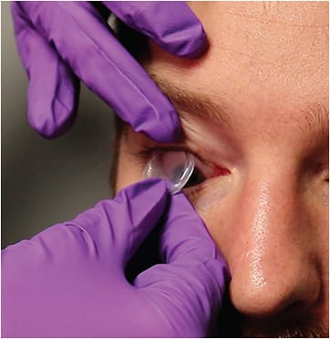 Figure 1. Prokera cryopreserved amniotic membrane (Biotissue) being placed on a patient.