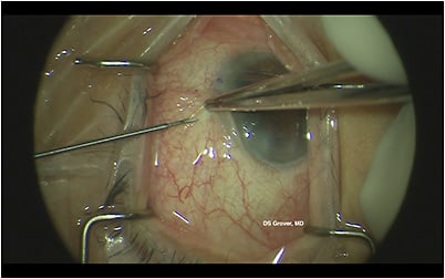 Figure 2. Closed-conjunctiva ab-externo implantation of Xen gel stent (Allergan). Images courtesy of Davinder S. Grover, MD.