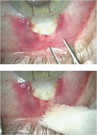 Figure 1. Open-conjunctiva ab-externo implantation of Xen gel stent (Allergan). Images courtesy of Joseph F. Panarelli, MD.