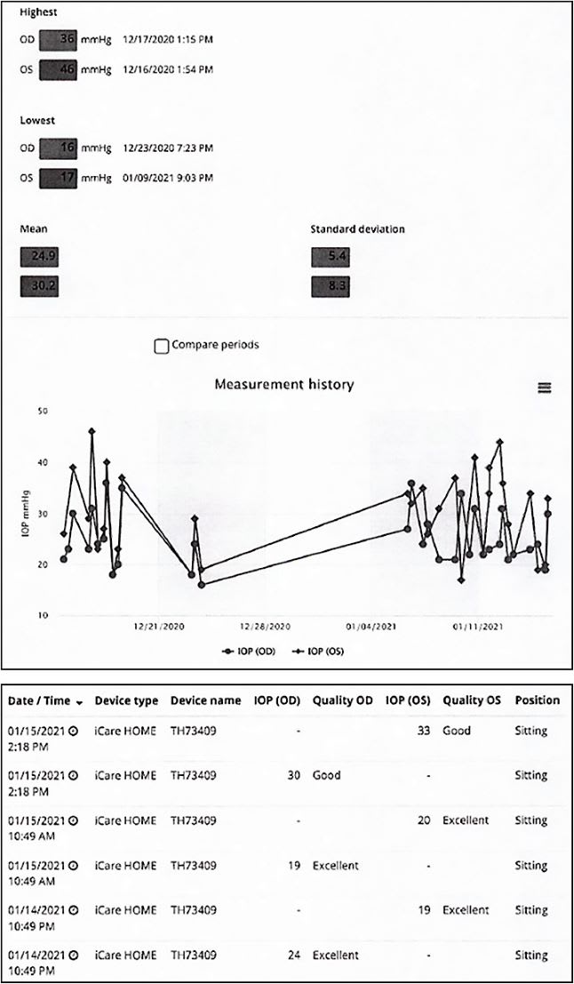 Figure 1. Home intraocular pressure (IOP) monitoring results for a 28-year-old female patient who has juvenile open-angle glaucoma, with IOP initially ranging from 16 mmHg to 22 mmHg in the office. Elevated IOP readings measured with a remote IOP-monitoring device (iCare Home) corresponded to headaches the patient was experiencing intermittently. Surgery was performed in both eyes, and the patient’s IOP stabilized.