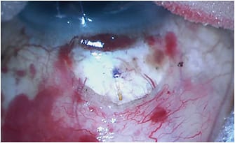 Figure 4. Xen 45 delivered via an open conjunctival technique.