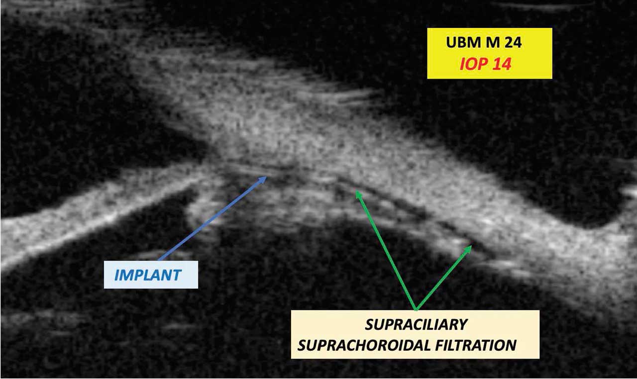 Figure 2. Ultrasound biomicroscopy examinations were carried out in the SAFARI III trial and demonstrated that there was no movement of the implant, no foreign body reaction, and no encapsulation. Supraciliary and suprachoroidal filtration were demonstrably visible in approximately 60% of cases.