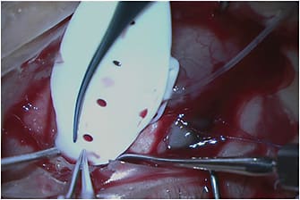 Figure 2. Example of a nonvalved GDI: Baerveldt Glaucoma Implant, model BG 101-350.