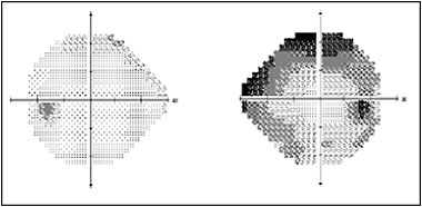 Figure 2. Humphrey visual fields demonstrating asymmetric nerve damage with superior and inferior arcuate defects in her right eye.