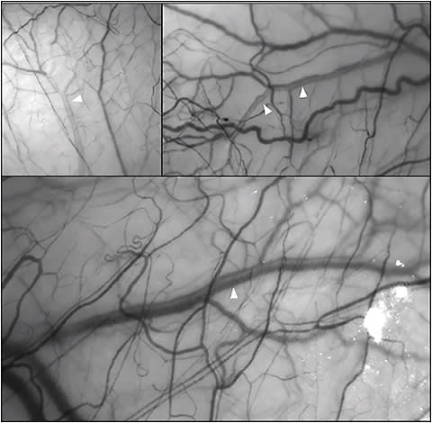 Figure 2. Hemoglobin video imaging is a technique to observe aqueous flow into the vascular system. The aqueous veins are marked with white arrows; aqueous appears as a centralized erythrocyte void. Reprinted via creative commons license from Khatib TZ, Meyer PAR, Lusthaus J, Manyakin I, Mushtaq Y, Martin KR. Hemoglobin video imaging provides novel in vivo high-resolution imaging and quantification of human aqueous outflow in patients with glaucoma. Ophthalmol Glaucoma. 2019;2(