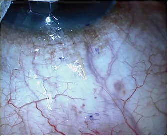 Figure 3. Xen 45 delivered via a closed conjunctival technique.