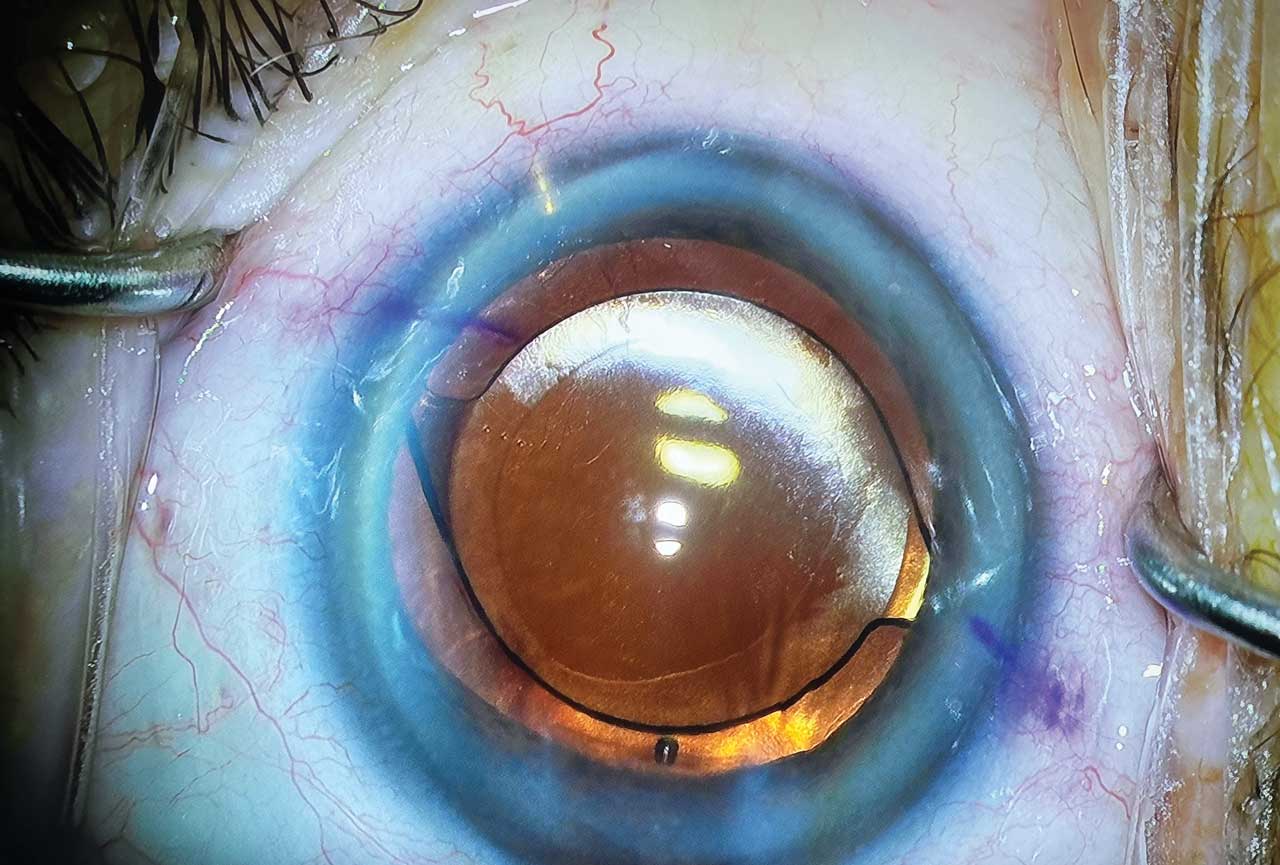 Figure 2. iDose TR (Glaukos) after implantation.