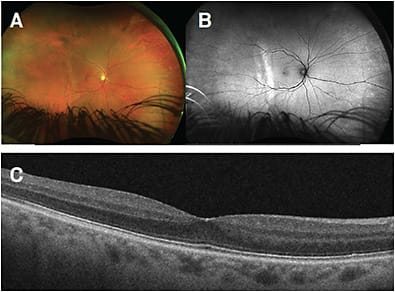 FIGURE 3: Multimodal imaging of the right eye at post-op month 4 visit: (A) Optos color fundus photo; (B) Optos autofluorescence revealing the subtle past resolved choroidal fold lines temporally; (C) OCT 5-line raster scan of the macula depicting a normal-appearing macula.