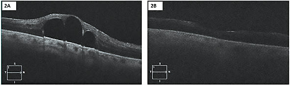 FIGURE 2: The submacular PFO was aspirated transretinally using a softtip cannula. Before surgery (A) vs. postsurgery (B). IMAGE COURTESY OF CARL REGILLO, MD.