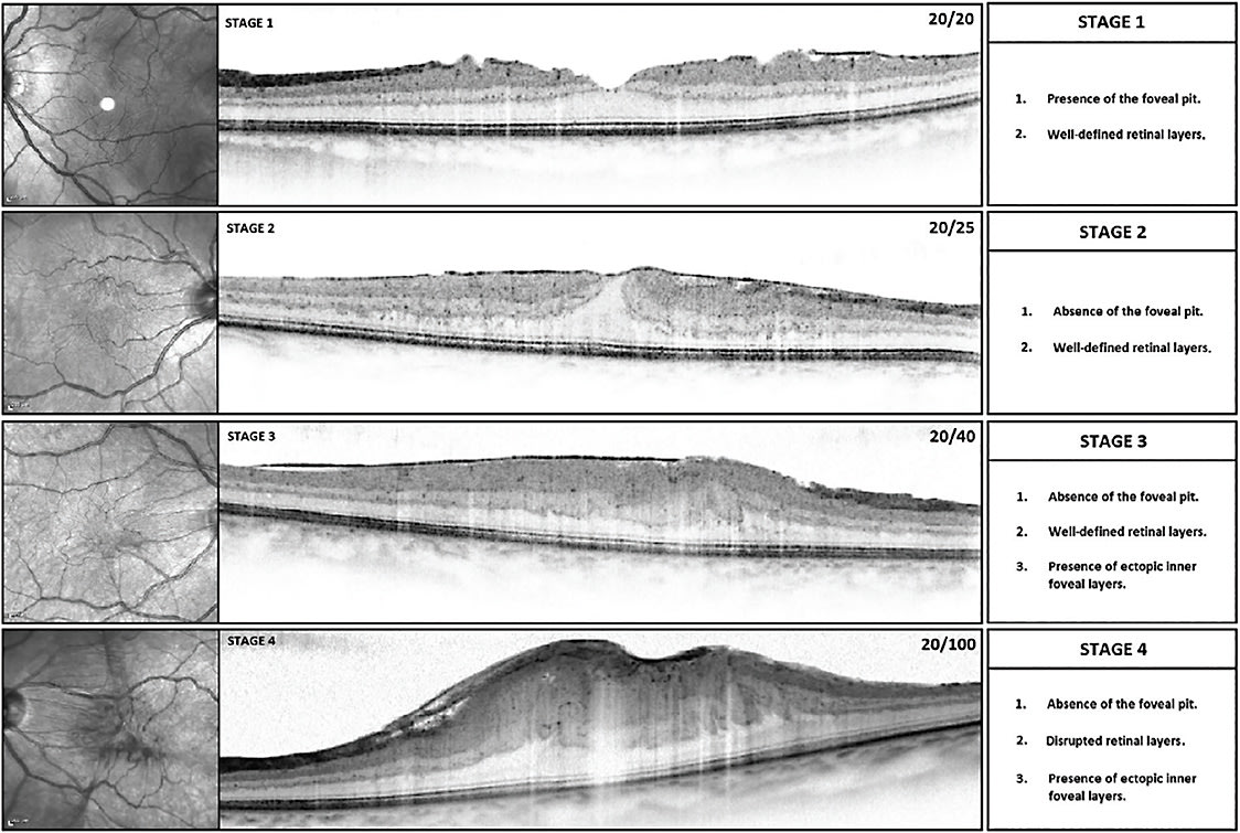 FIGURE 3: Series of optical coherence tomography images demonstrating a proposed staging scheme in which finally by Stage 3 there are ectopic inner layers within the middle retina. Note that the INL and IPL have entered the umbo where they are typically not found in age-matched normal retinal layers and in Stage 1 and Stage 2. IMAGE COURTESY ZACK OAKEY, MD